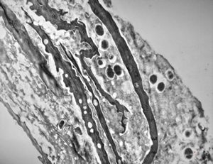 M,68y. | auditory meatus … otitis externa mycotica